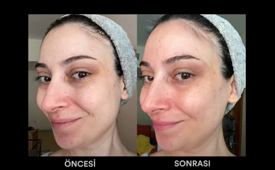 Foreo BEAR öncesi sonrası değişim